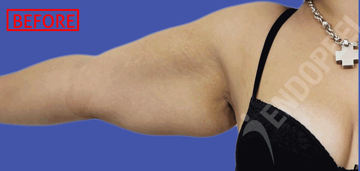 arm-lift-animated-copy