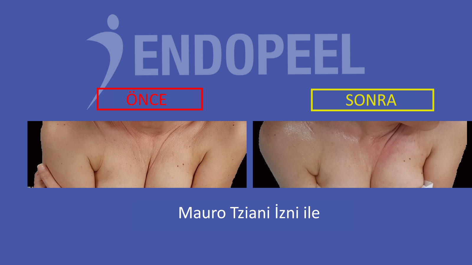 dekolte cilt kırışıklıkları