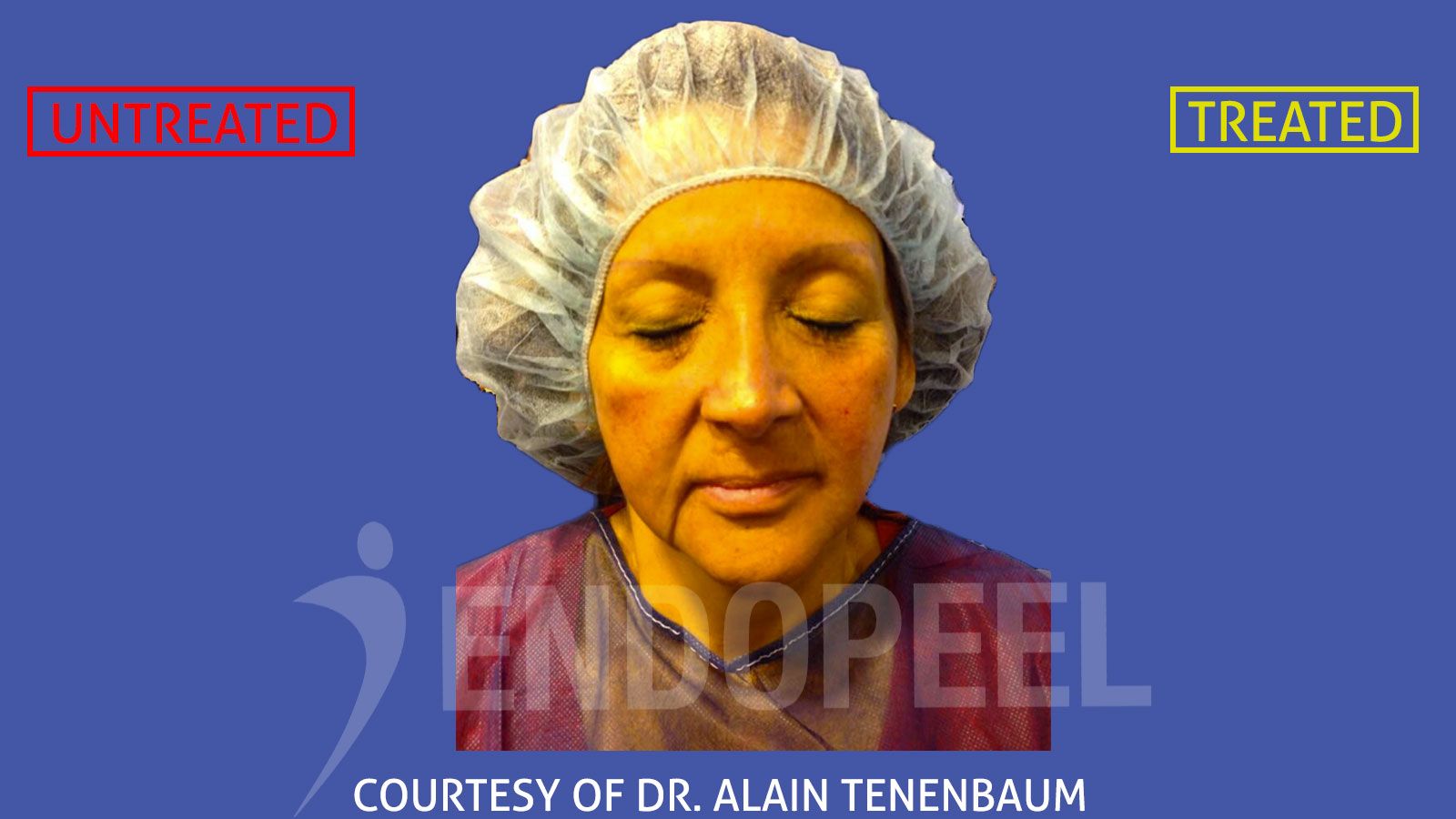 Yüz çevresi Dr.Alain Tenenbaum