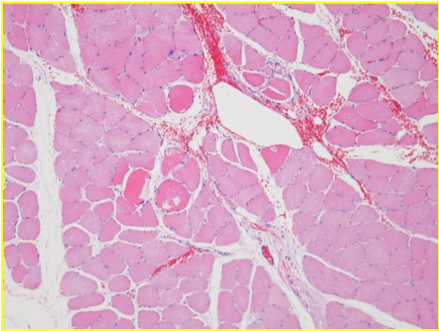 hidroksibenzen nekrozu