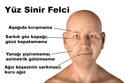 Yüz Felci