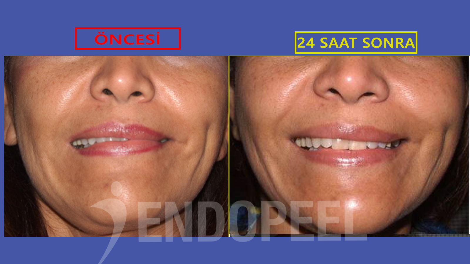 endopeel ve yüz felci