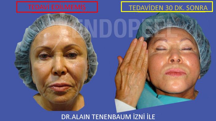 endopeel ile yüz ve boyun
