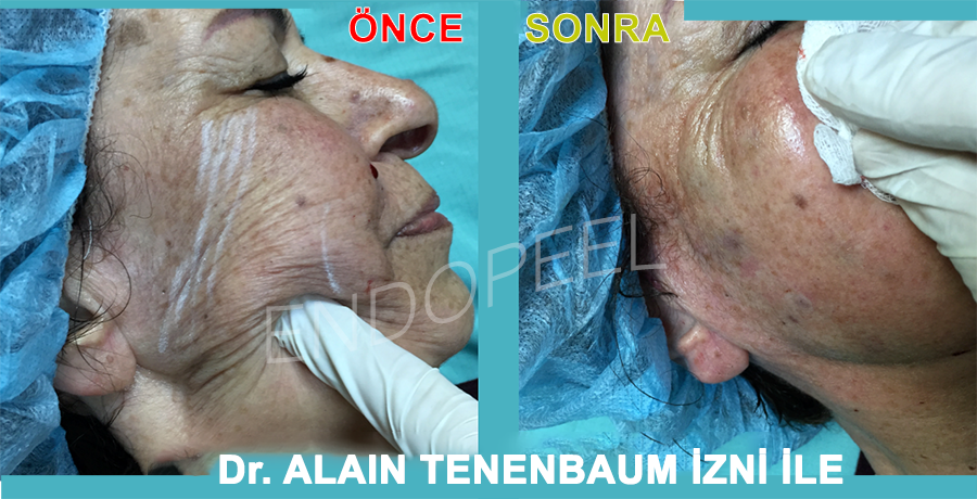 skin-moisturizing-hydration-endopeel