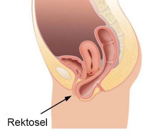 rektosel