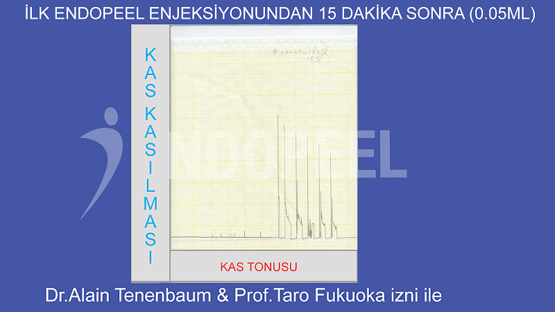 0.05 ml'lik 1. endopeel enjeksiyonundan 15 dakika sonra